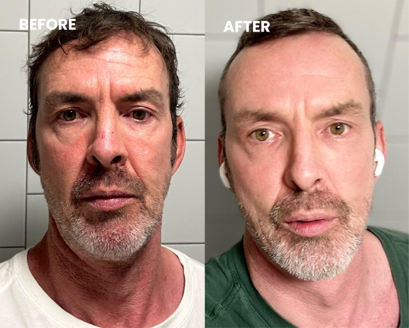 A before and after comparison of a man's face, showing a healthier and more groomed appearance on the right.