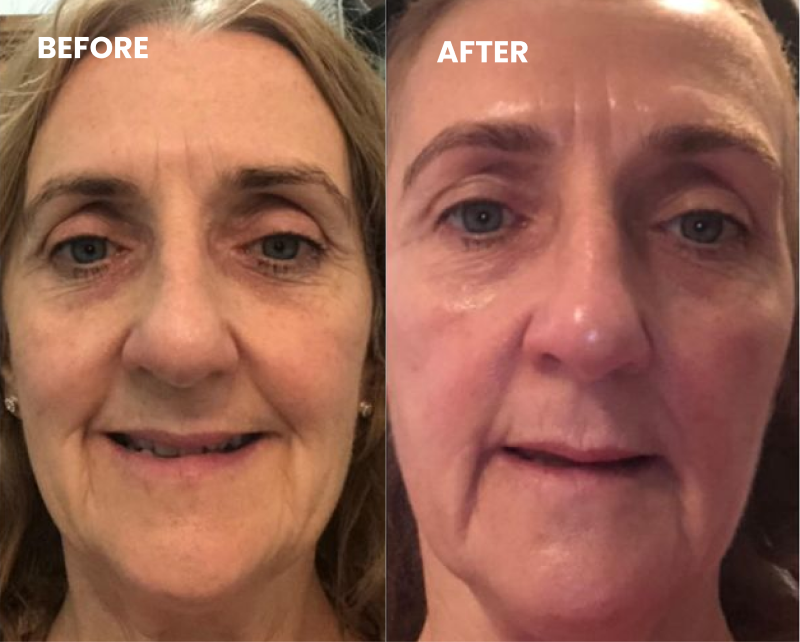 A before and after comparison of a woman's face, showing changes to her skin and wrinkles.