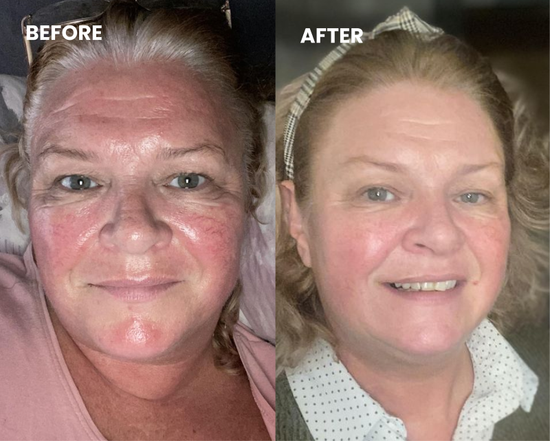 Before and after photos of a woman's face, showing a significant reduction in skin redness and inflammation.