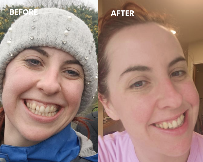 A before and after split-screen image of a smiling woman's face, showing differences in skin appearance.