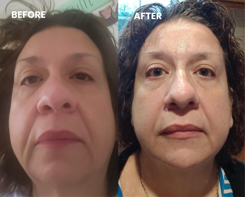 A side-by-side before and after image of a woman's face, showing a reduction in puffiness and wrinkles.