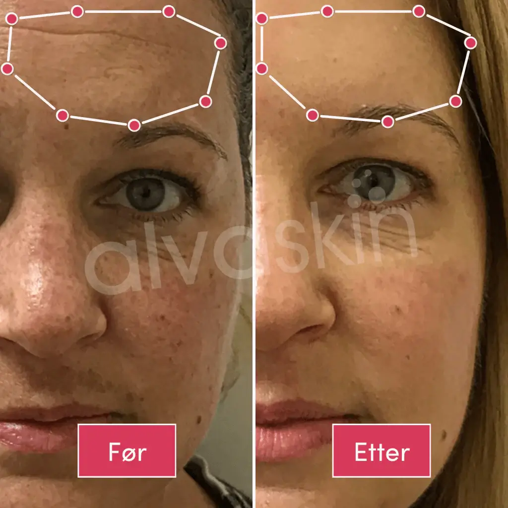 Side-by-side comparison of a woman's forehead before and after treatment.