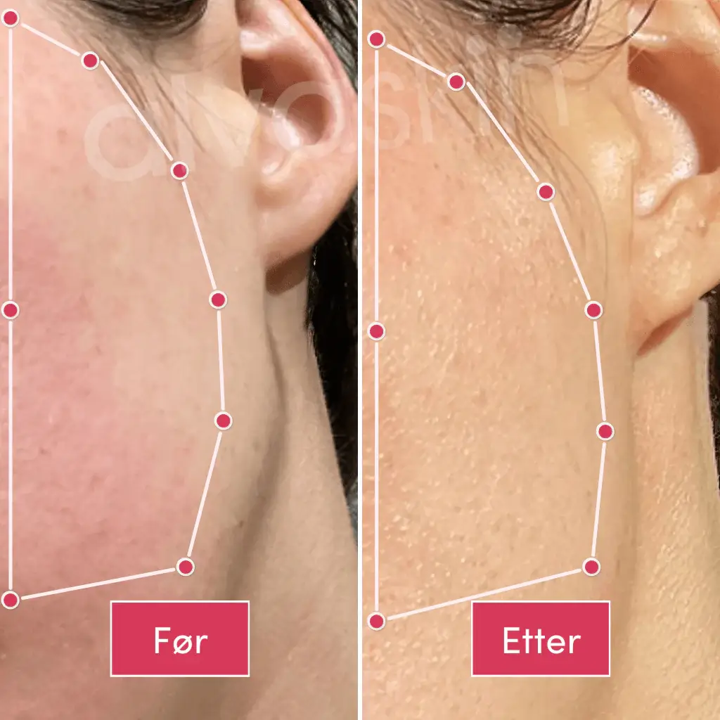 Side-by-side comparison of skin texture, labeled 'Før' and 'Etter.'