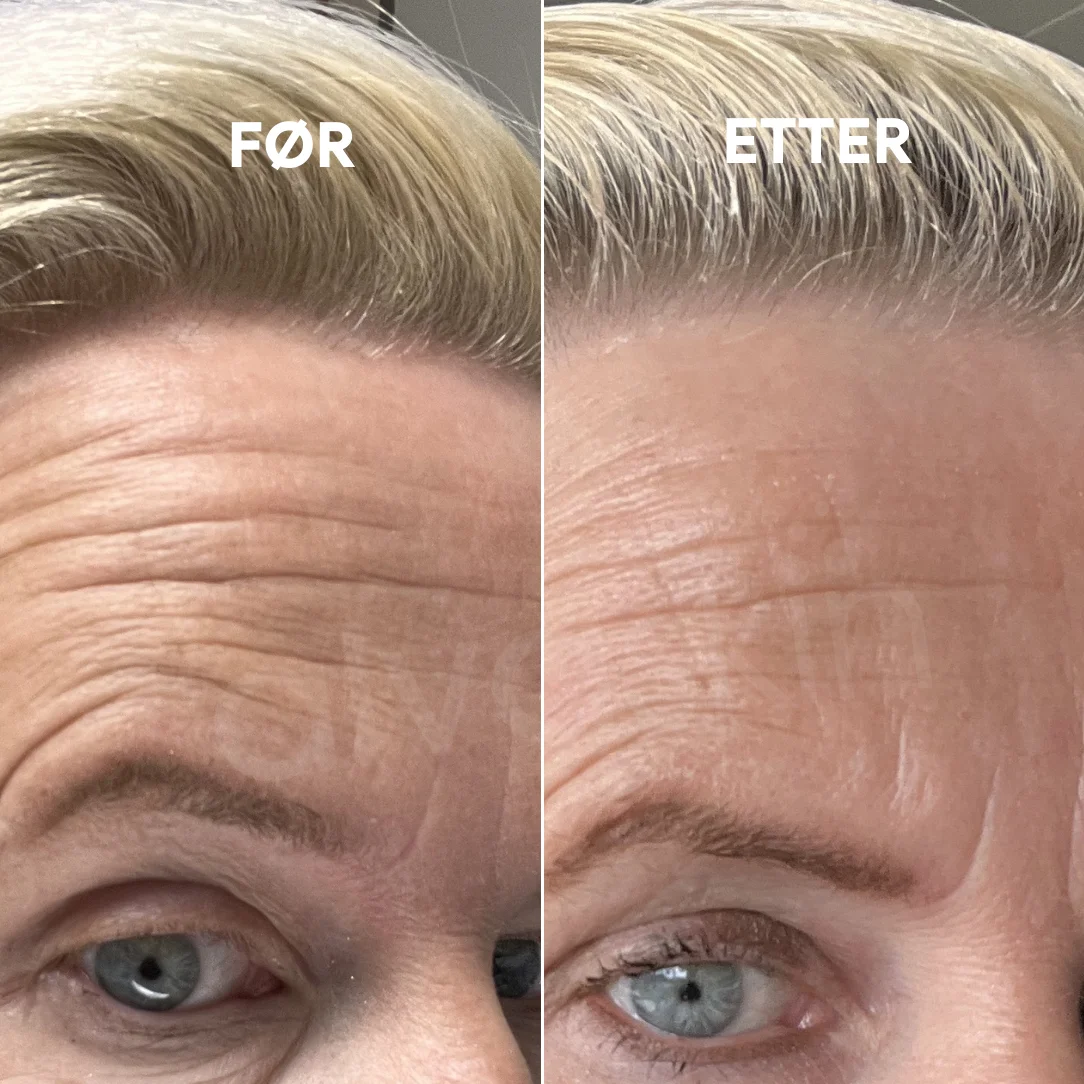 Side-by-side comparison of a forehead before and after, showing fewer wrinkles.