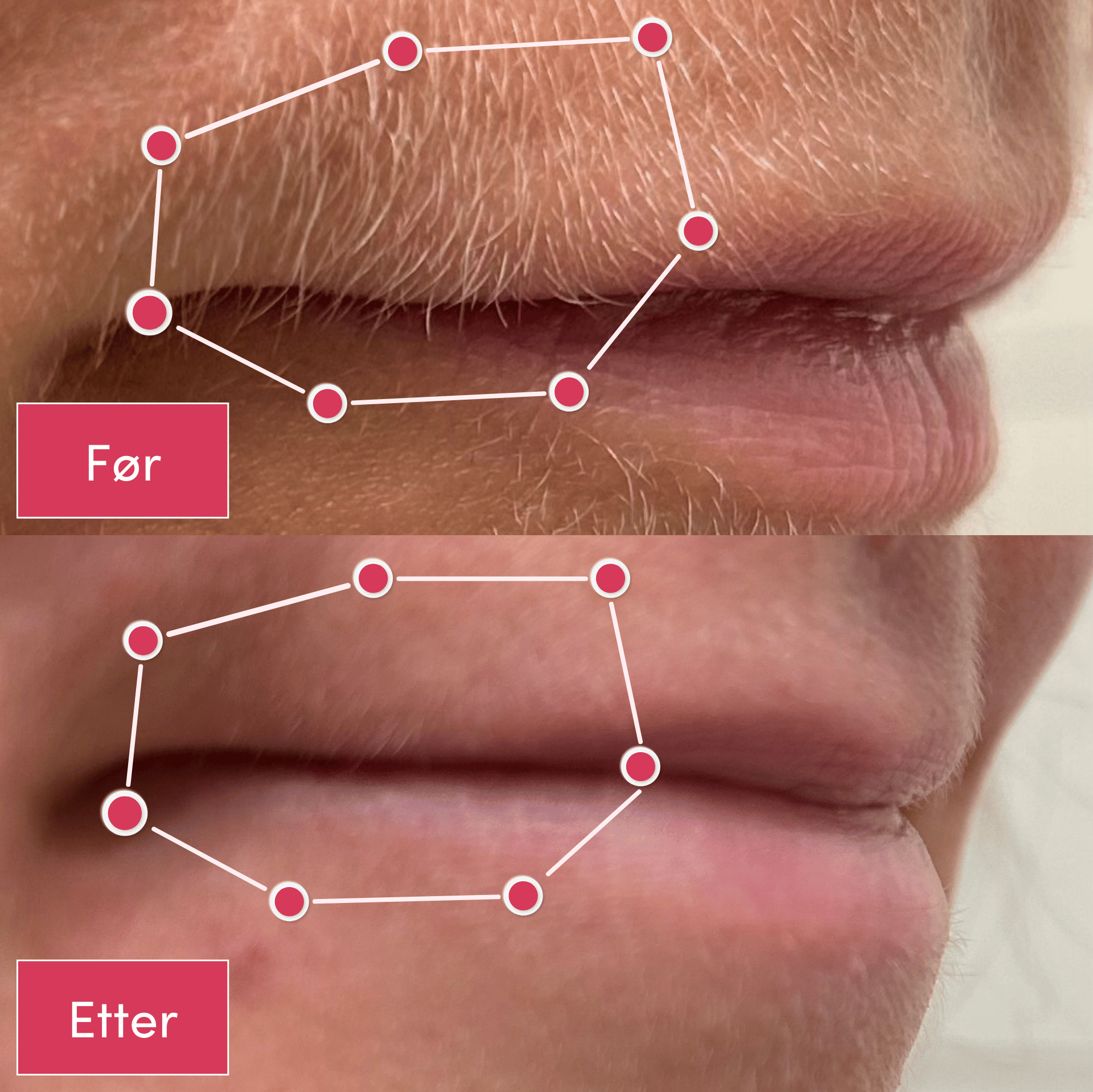 Two close-up images of a person's upper lip, labeled 'Før' and 'Etter.'