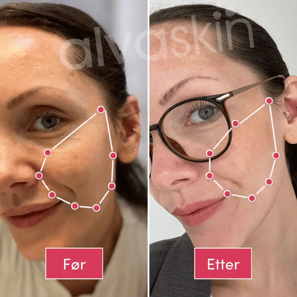 Side-by-side comparison of a woman's face before and after, with digital overlay and text labels.