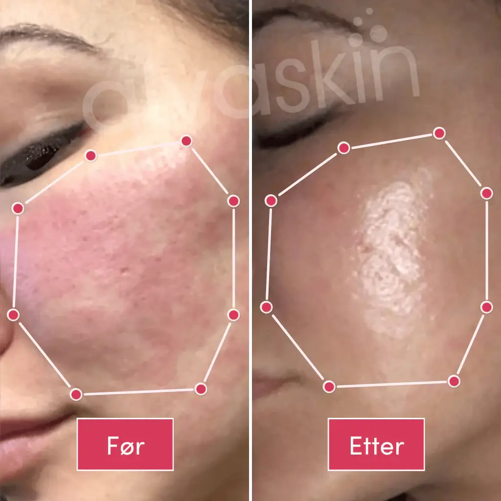Side-by-side comparison of skin texture before and after treatment.