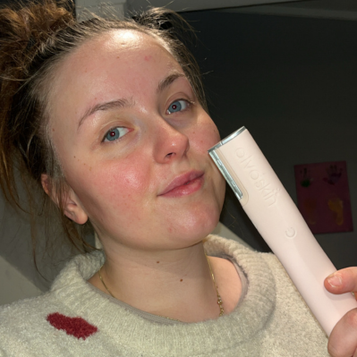 Side-by-side comparison of facial skin texture improvement.