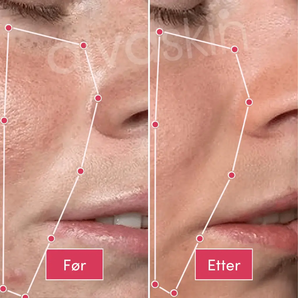 Close-up comparison of facial skin texture before and after treatment.