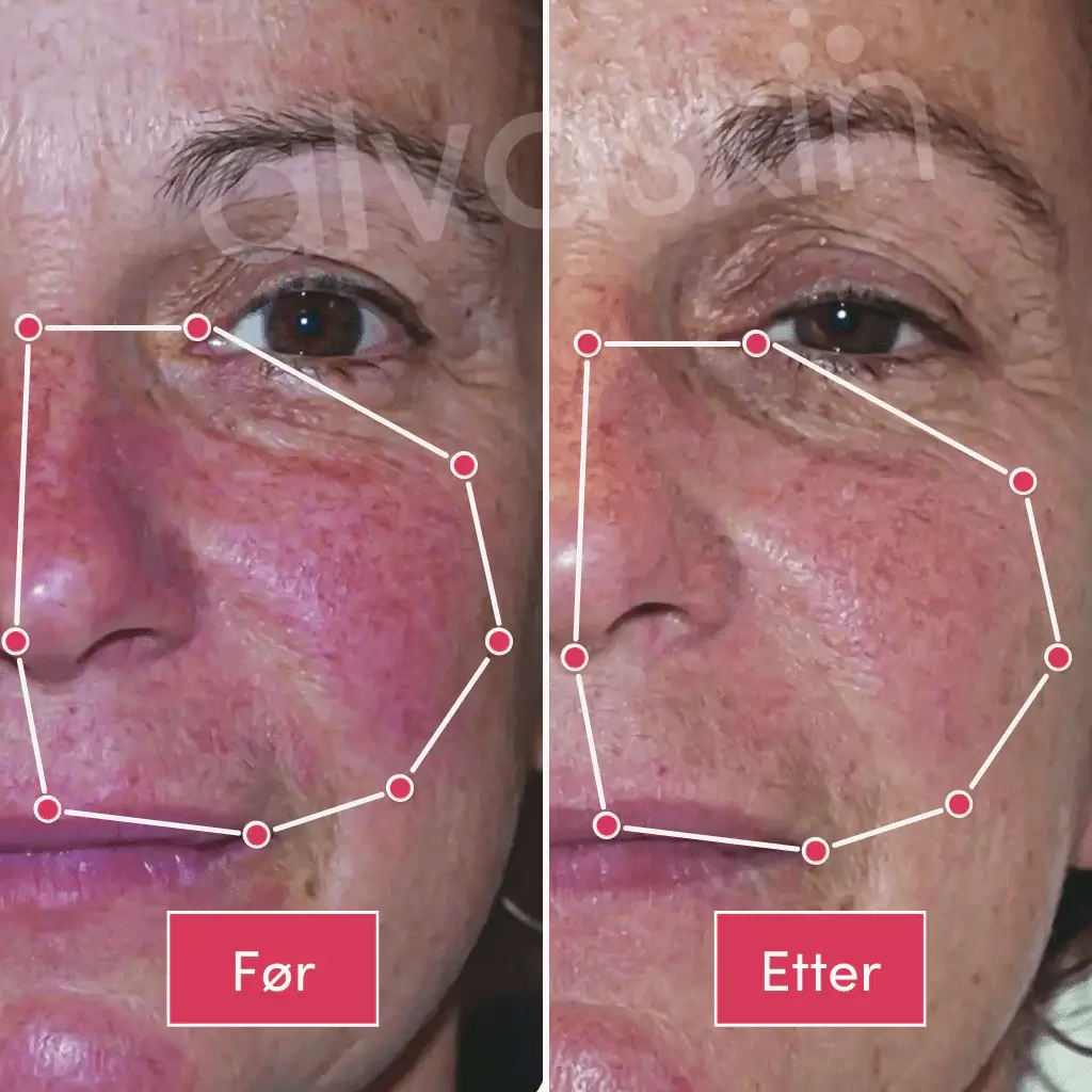Side-by-side images of a woman's face labeled 'Før' and 'Etter' with marked facial areas.