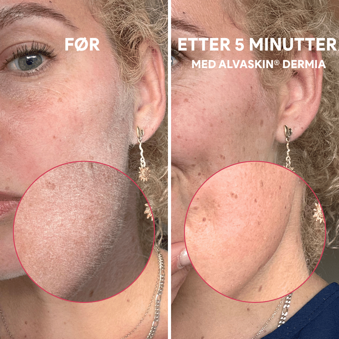 Before and after skincare treatment on a woman's cheek with visible improvement.