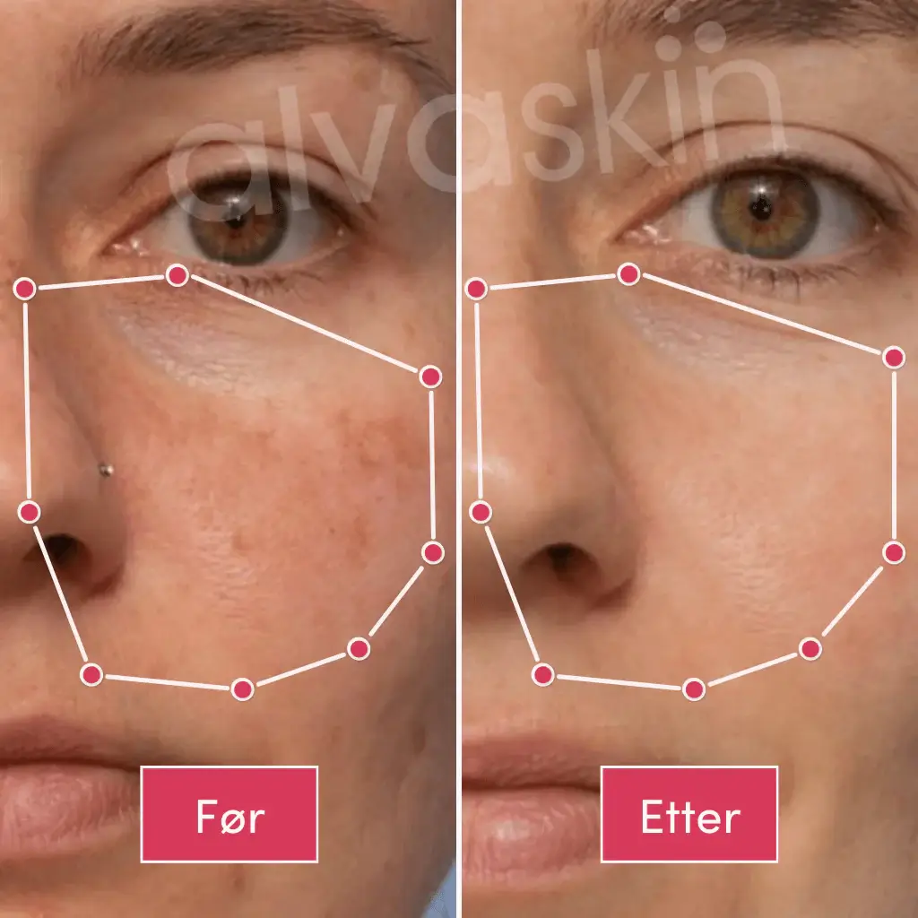 Side-by-side comparison of a woman's face before and after treatment.