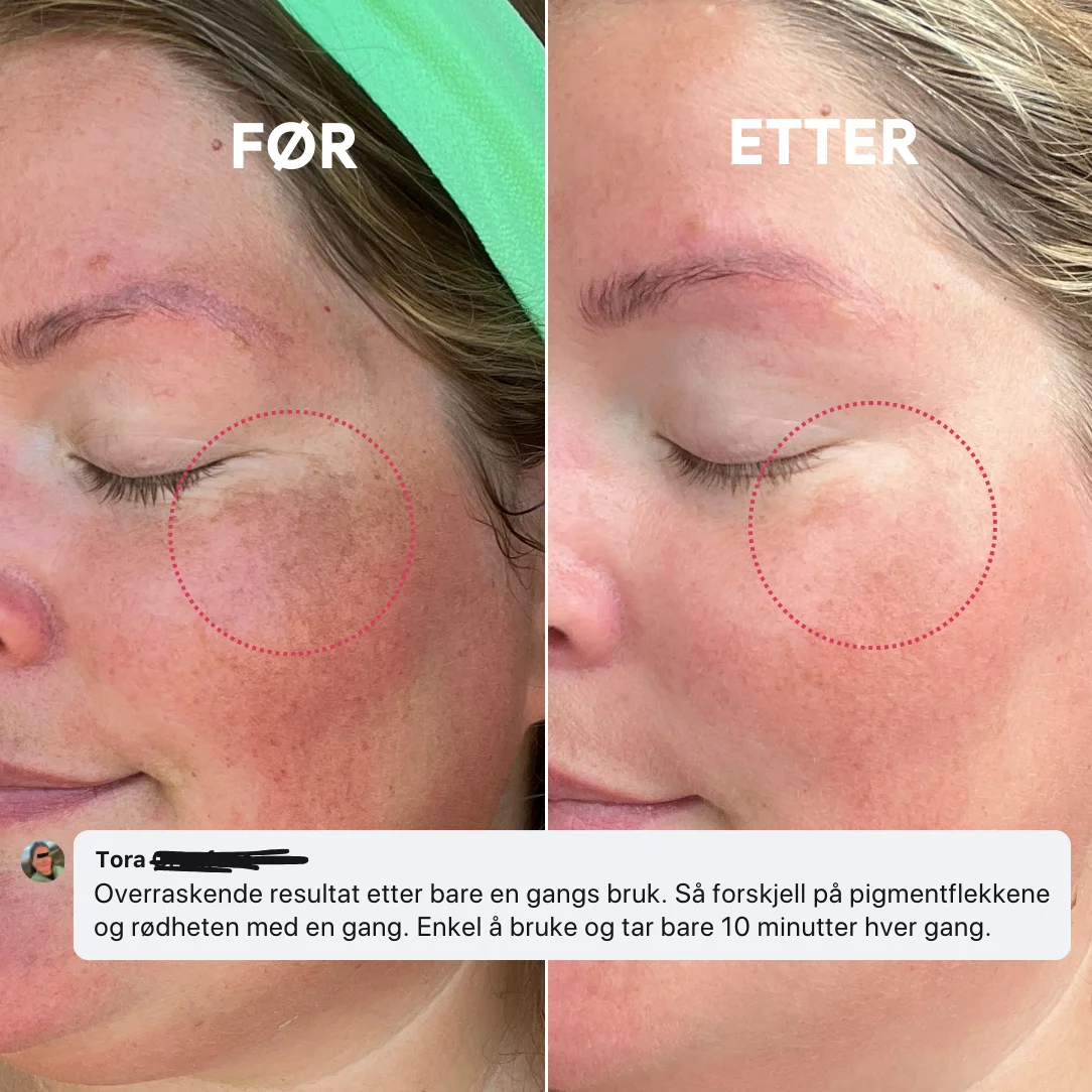 Side-by-side comparison of a woman's cheek before and after treatment.