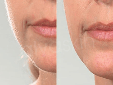 Before and after comparison of facial skin texture.