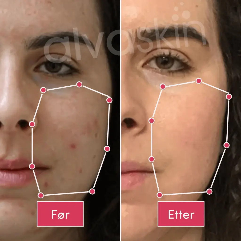 Side-by-side comparison of a face before and after skincare treatment.