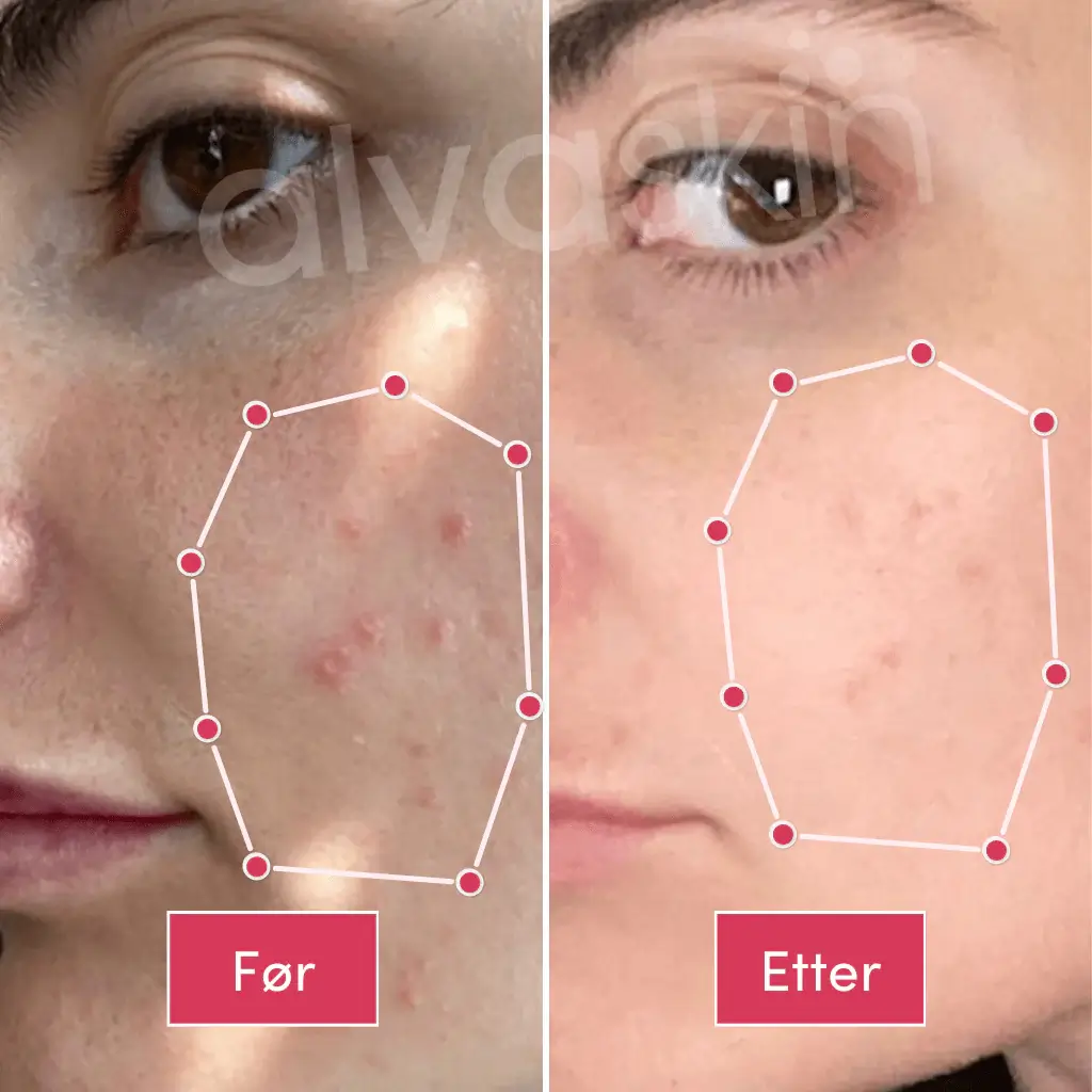Side-by-side comparison of skin with acne before and after treatment.