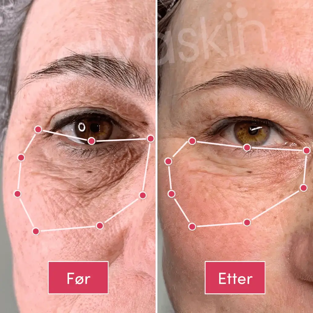 Side-by-side comparison of skin around the eye before and after treatment.