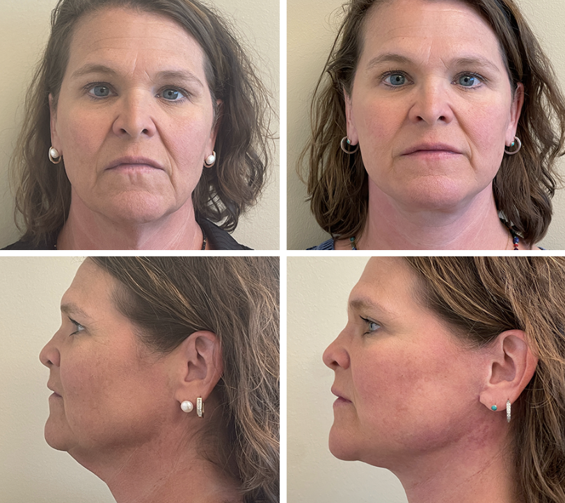 Four side-by-side photos of a woman's face from different angles.
