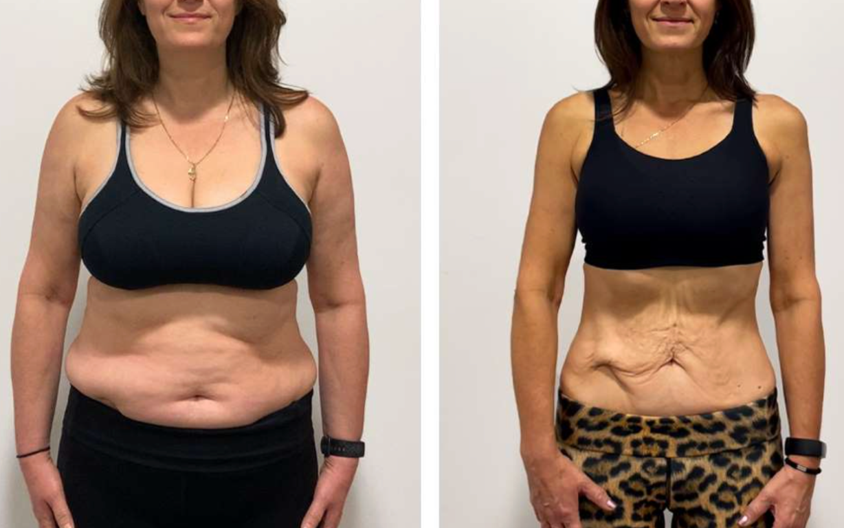 A woman in sportswear before and after weight loss transformation.
