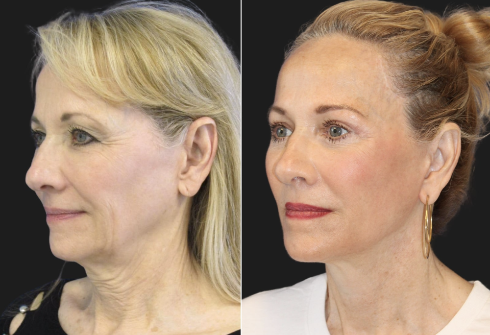 Side-by-side comparison of a woman's profile before and after a change in appearance.