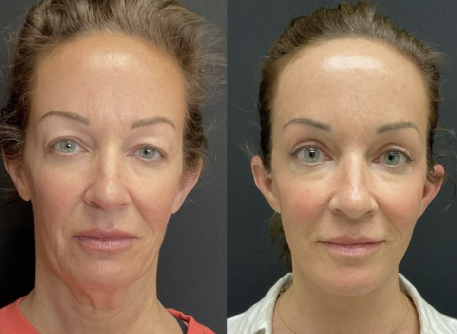 Side-by-side comparison of a woman's face before and after cosmetic procedure.