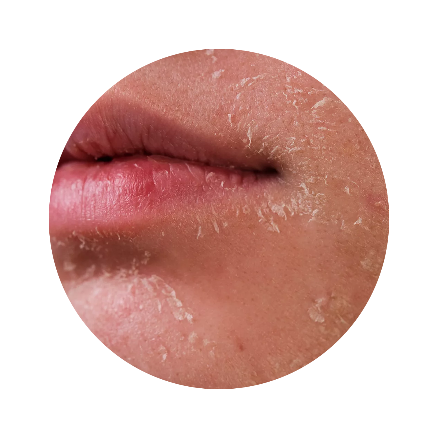 Close-up of lips and chin with dry, flaky skin.