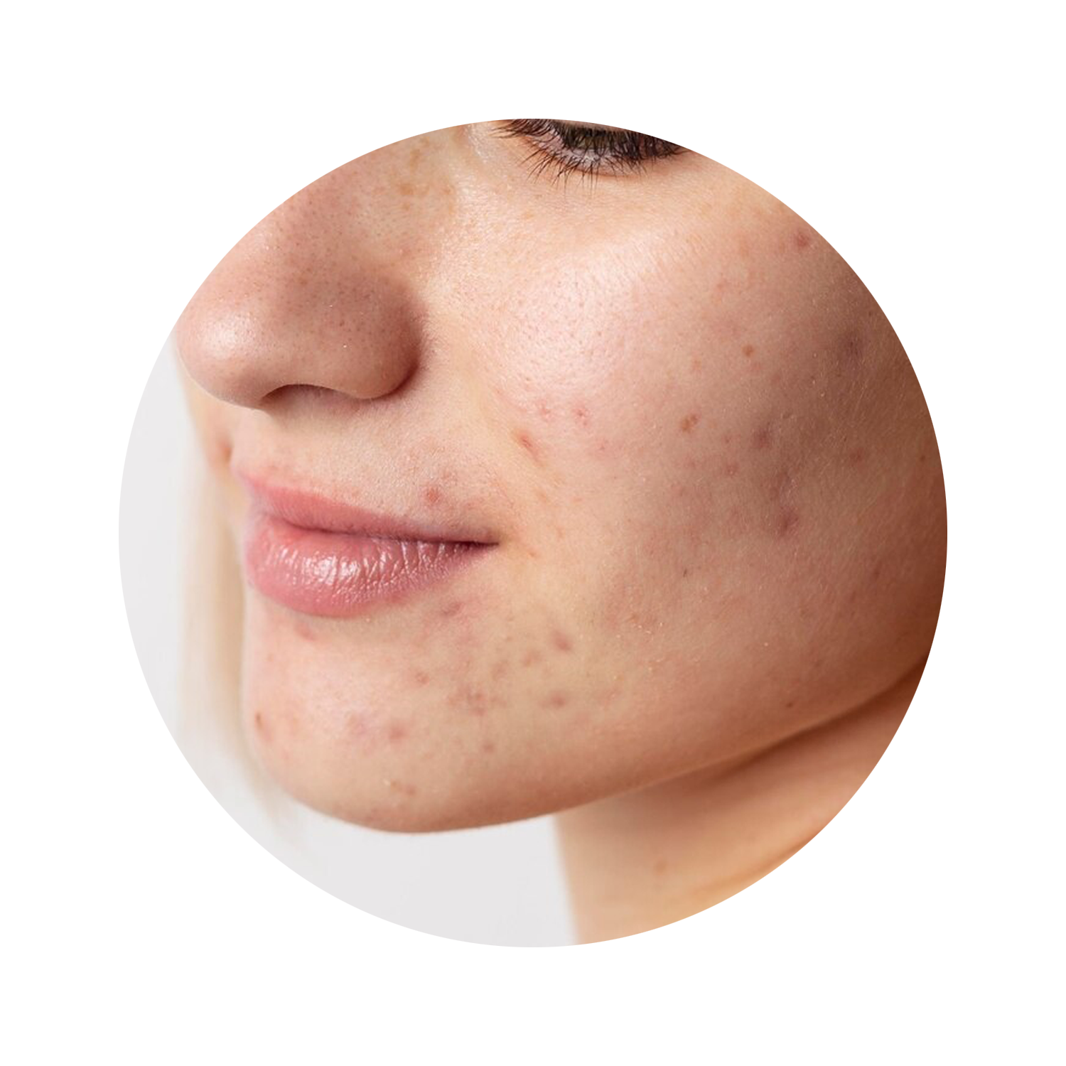 Close-up of a person's cheek with acne and freckles.