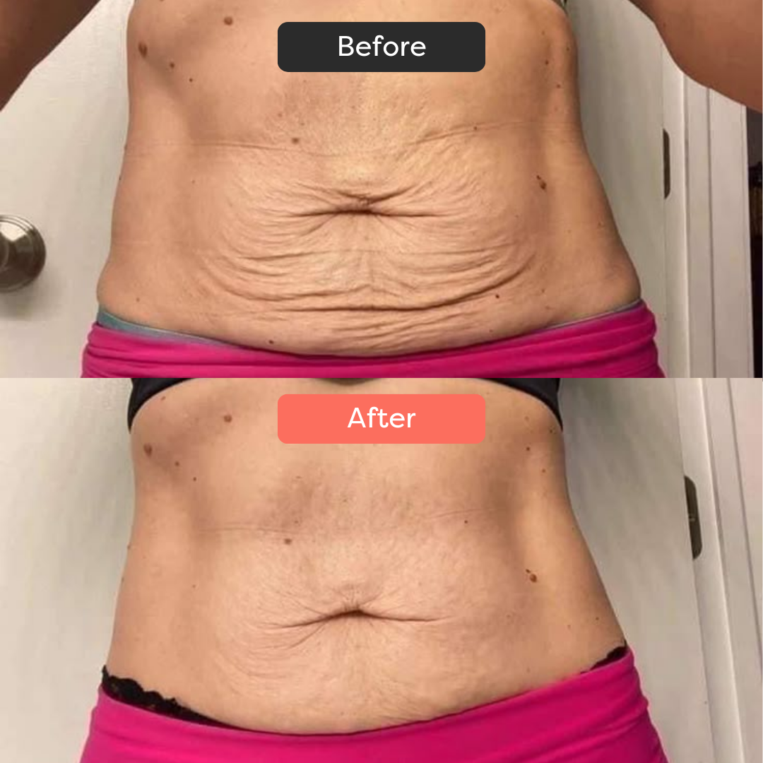 Before and after comparison of a person's abdominal area.
