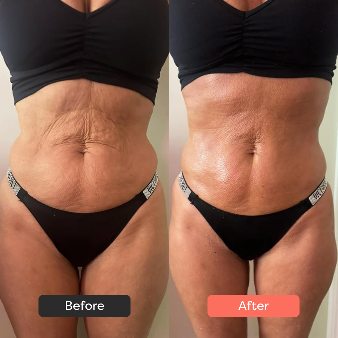 Side-by-side comparison of a woman's abdomen labeled 'Before' and 'After.'