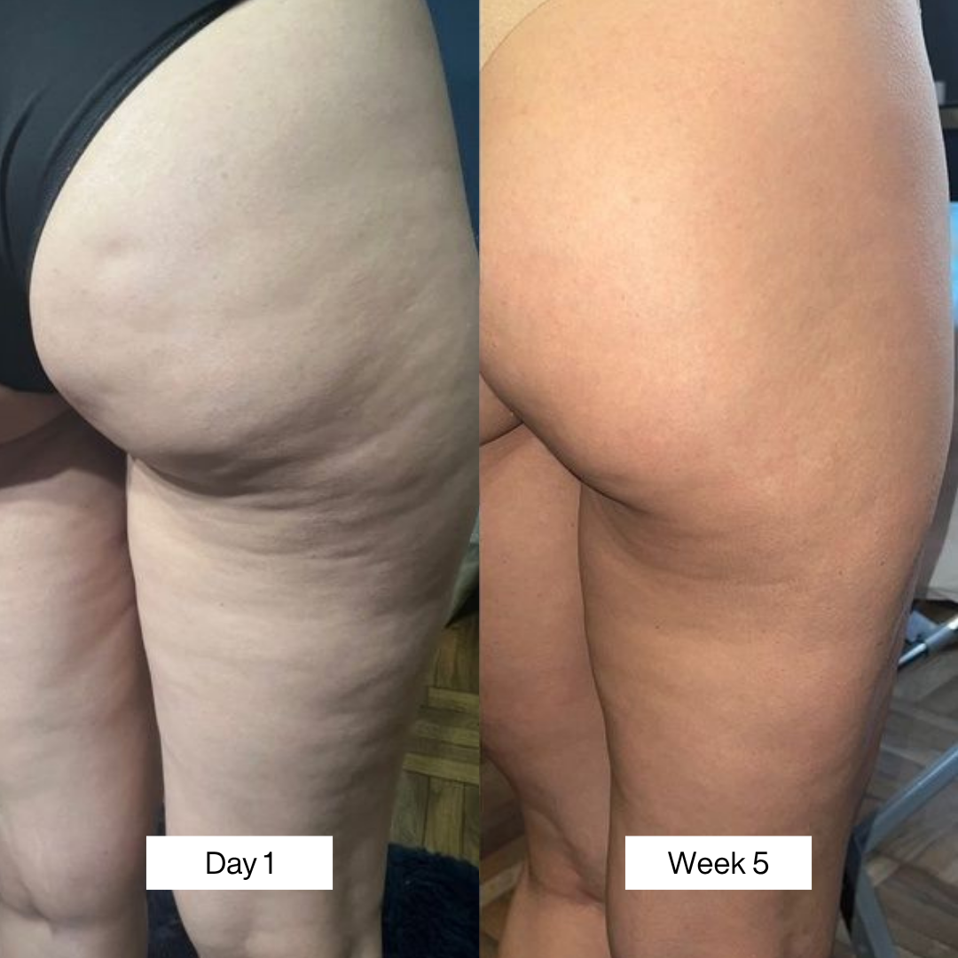 A before and after image showing the back of a person's thighs, with a reduction in cellulite.