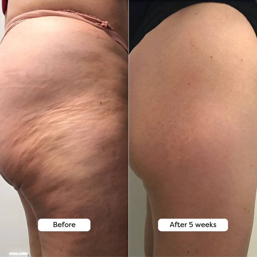 Side-by-side comparison of skin texture before and after five weeks.