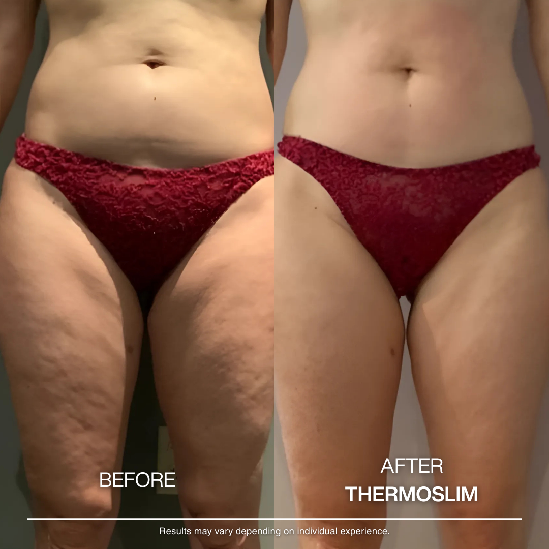 A before and after image showing a reduction of cellulite on a woman's thighs and abdomen.