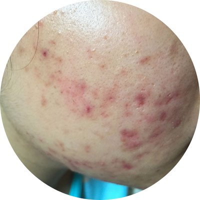 Close-up of a facial area with red acne and spots.