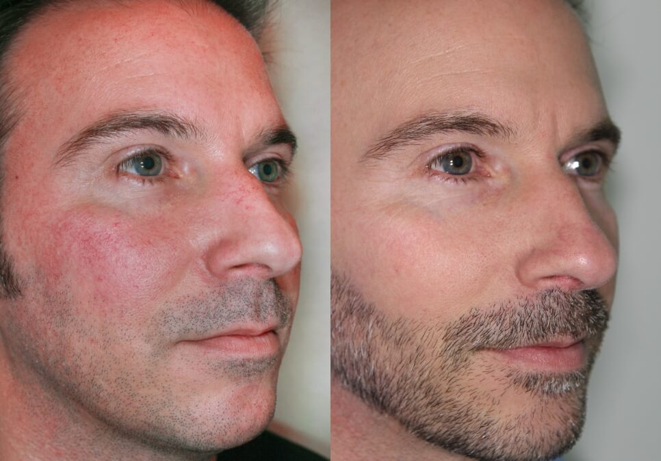Side-by-side comparison showing a man's face before and after treatment.