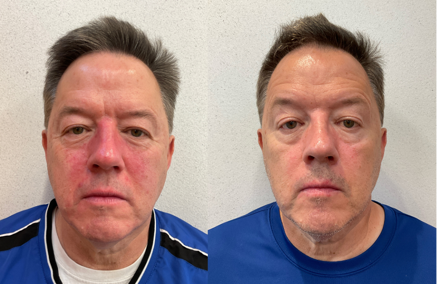 Two side-by-side images of the same man with different facial redness.