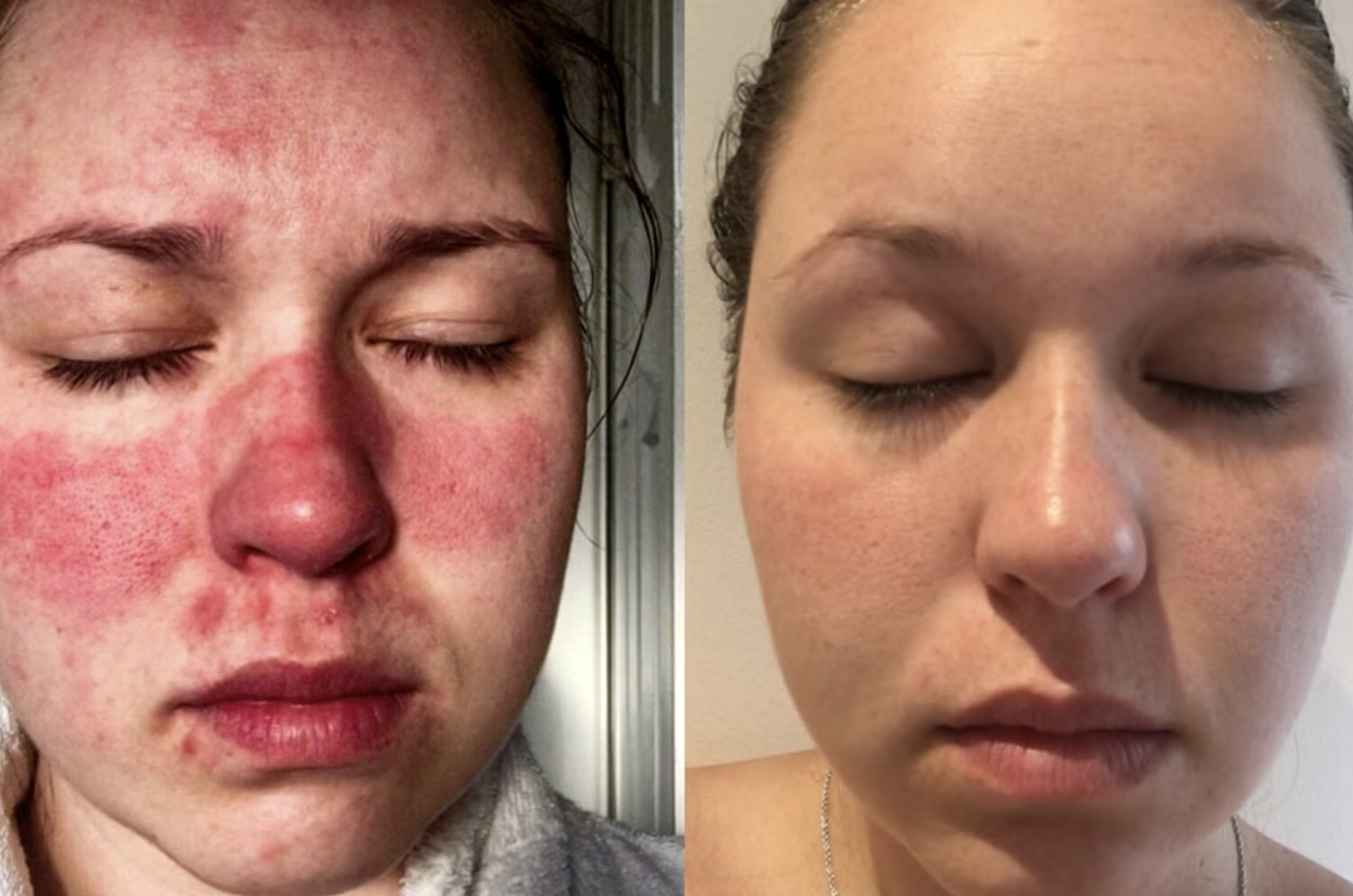 Two close-up images of a person's face with and without facial redness.