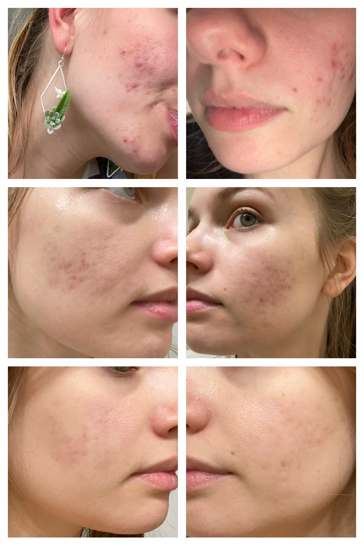Collage of close-up facial images showing skin texture and blemishes.