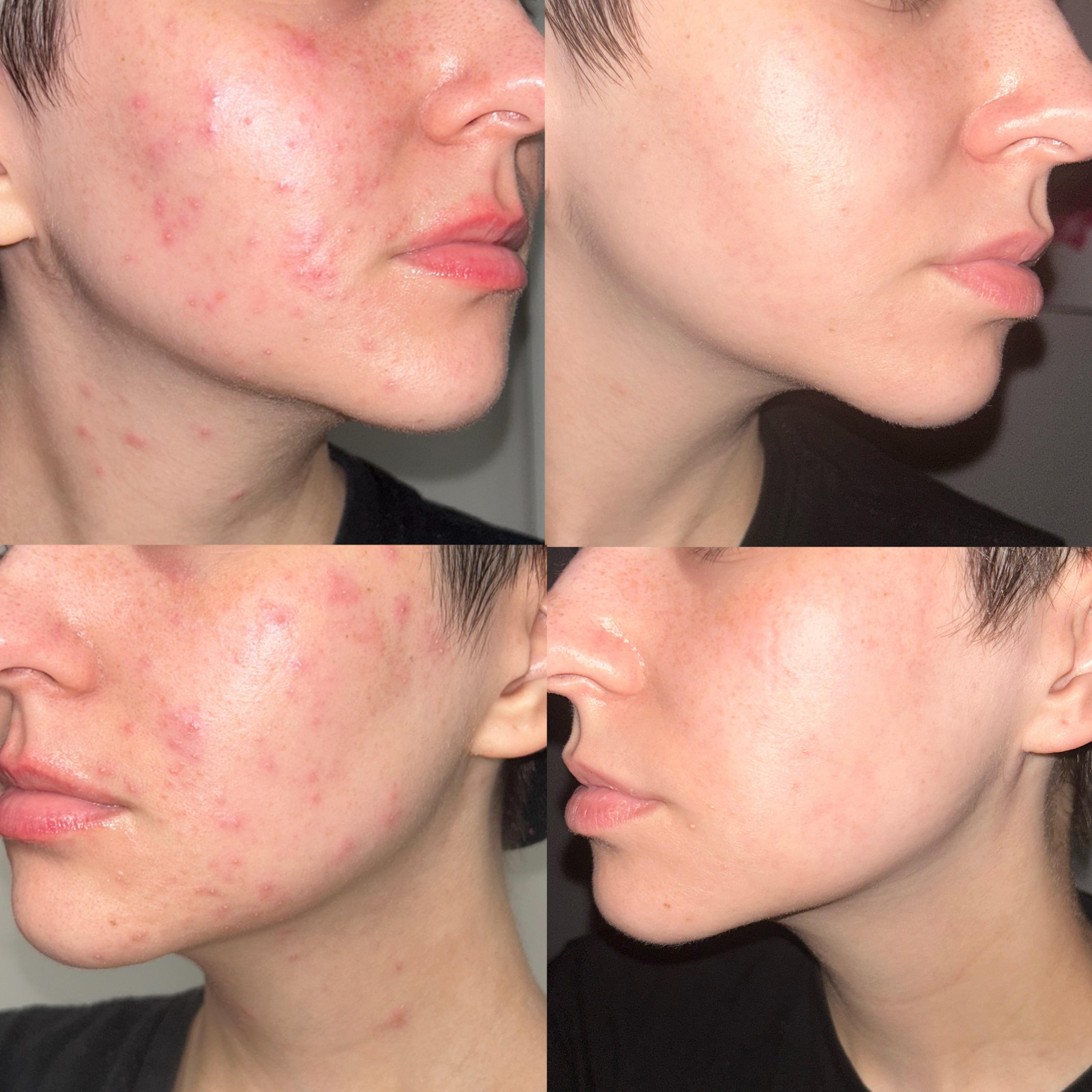 Four images showing before and after of acne treatment on the cheek.