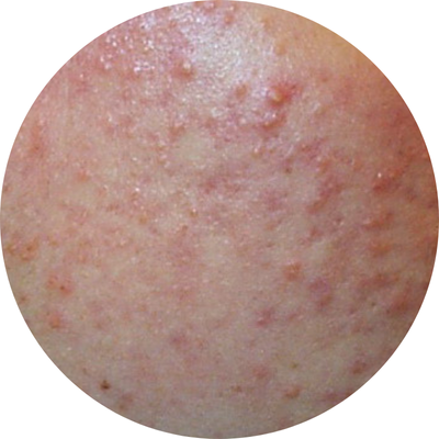 Close-up of skin with visible blemishes and redness.