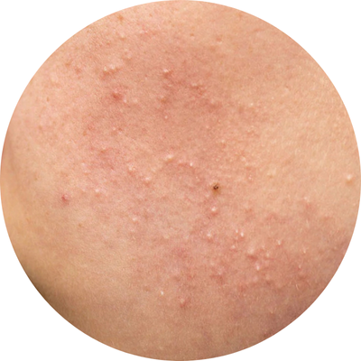Close-up of skin with small raised bumps.