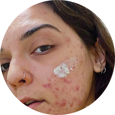 Person with acne and white cream on cheek.