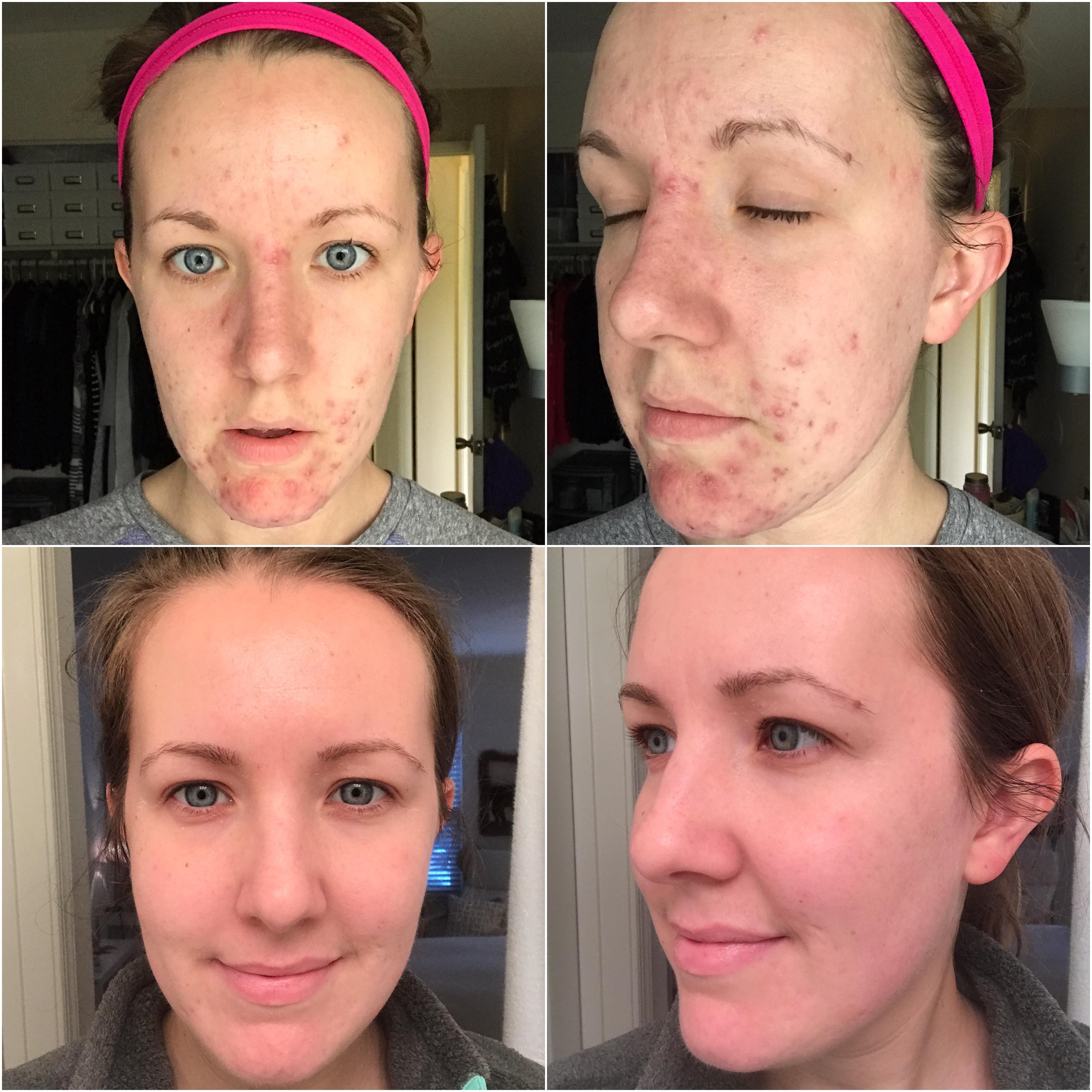 Collage of a woman showing acne before and clear skin after treatment.