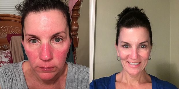 Side-by-side image of a woman with facial redness and without.
