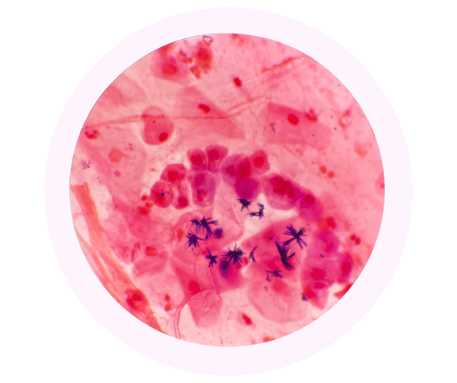 A circular micrograph of pink-stained cells with dark purple, spiky, star-shaped structures.