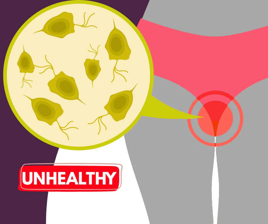 An illustration showing microorganisms causing an unhealthy infection in the female genital tract.
