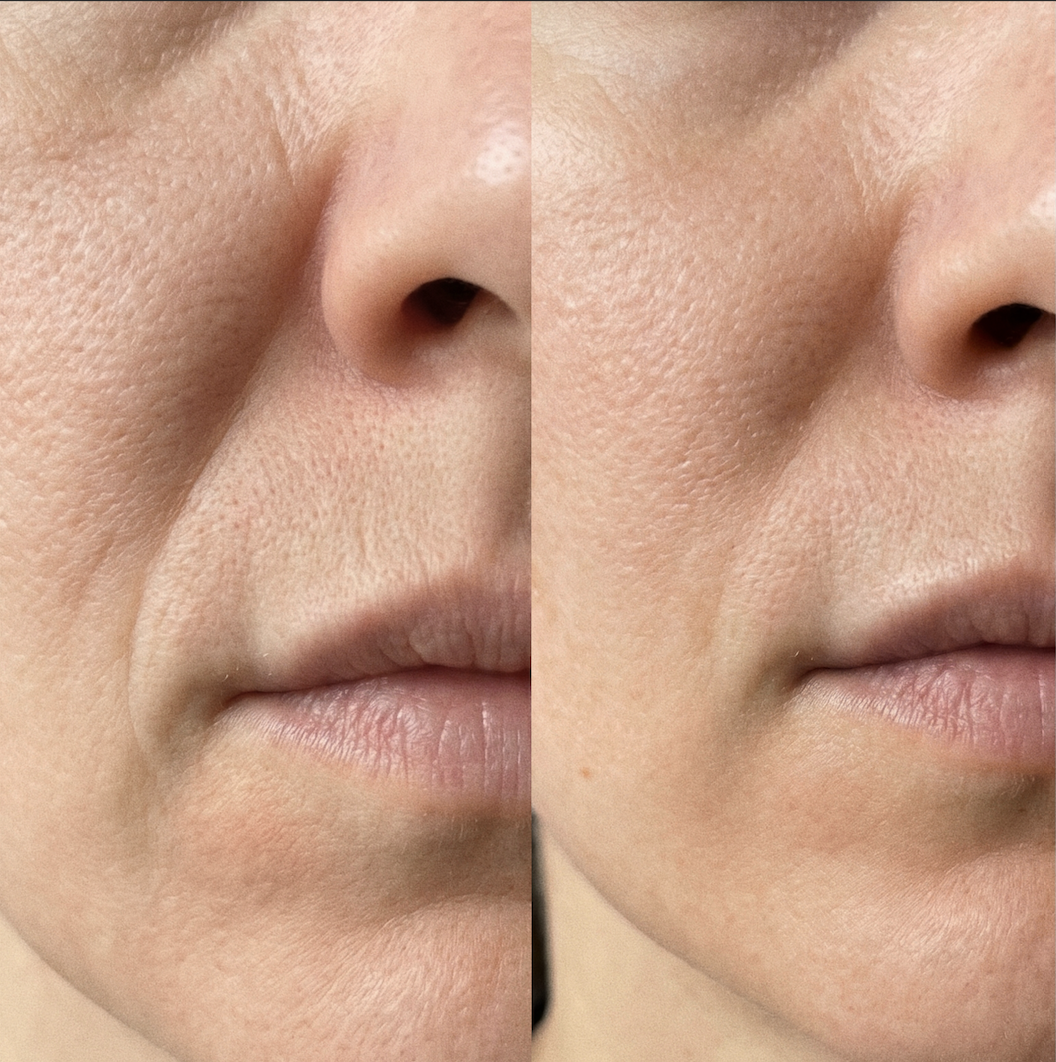 A before-and-after close-up showing the reduction of wrinkles around a person's nose and mouth.