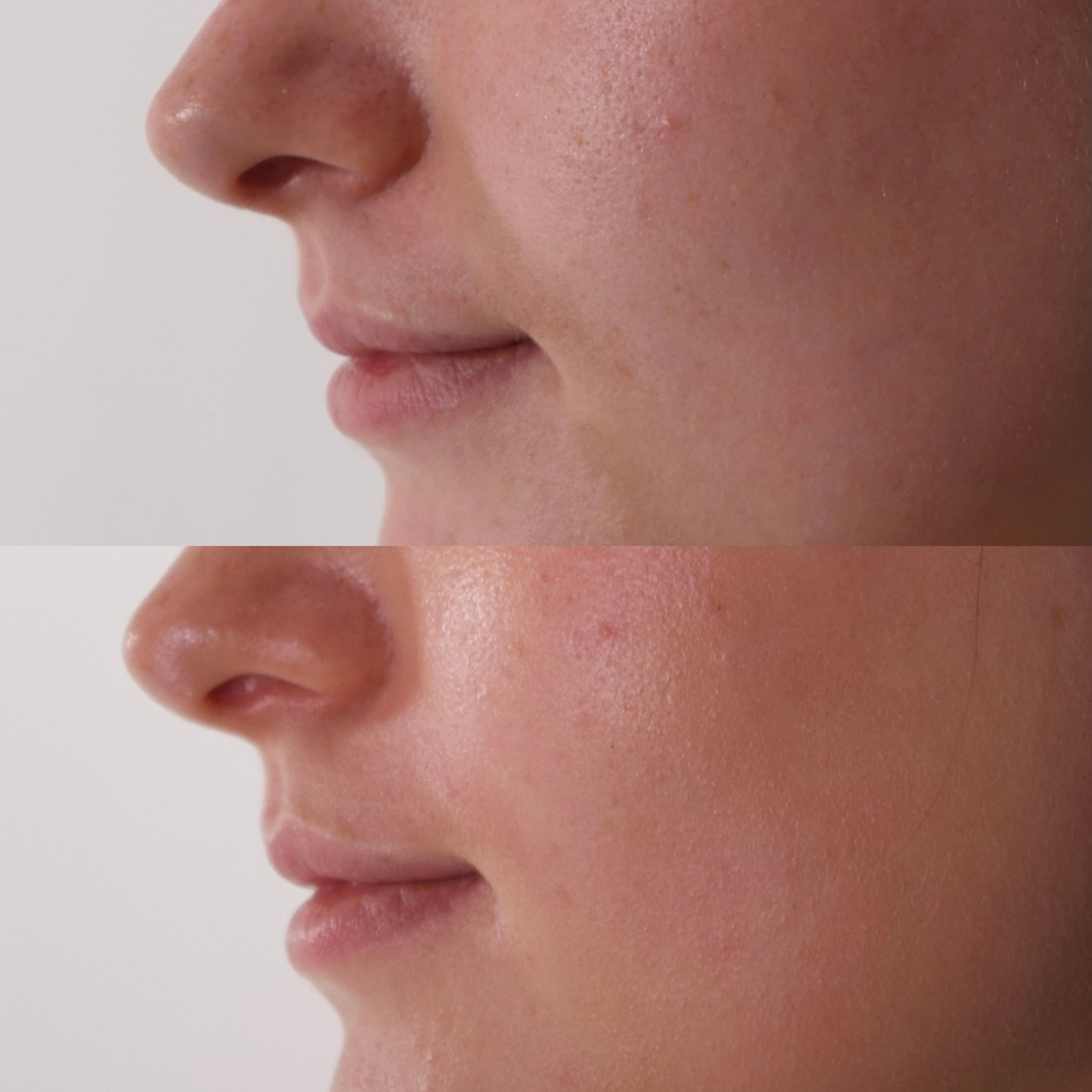 A before and after image showing a close-up of a person's face with improved skin texture.