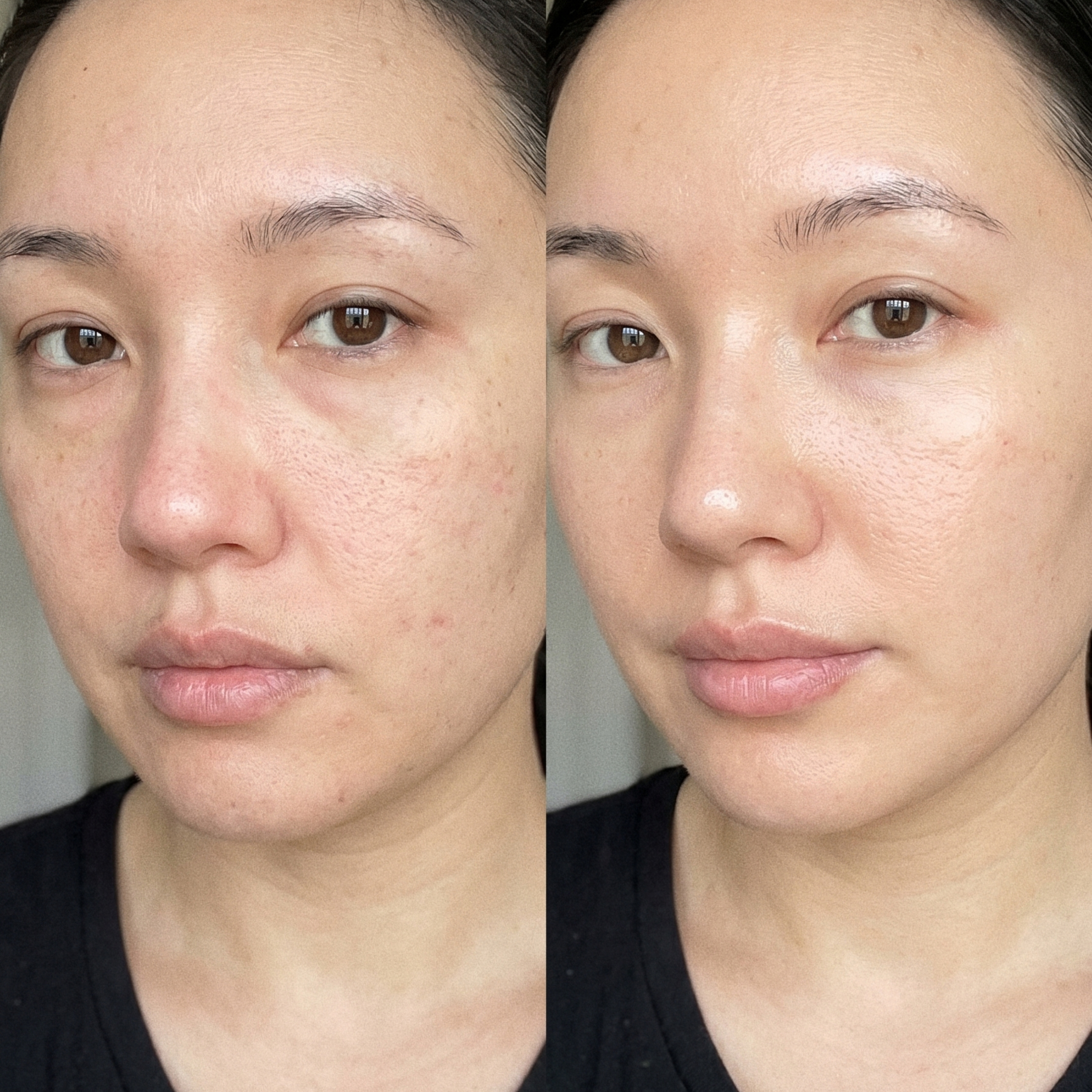A before-and-after comparison of a woman's face, showing improved skin texture and reduced redness on the right.