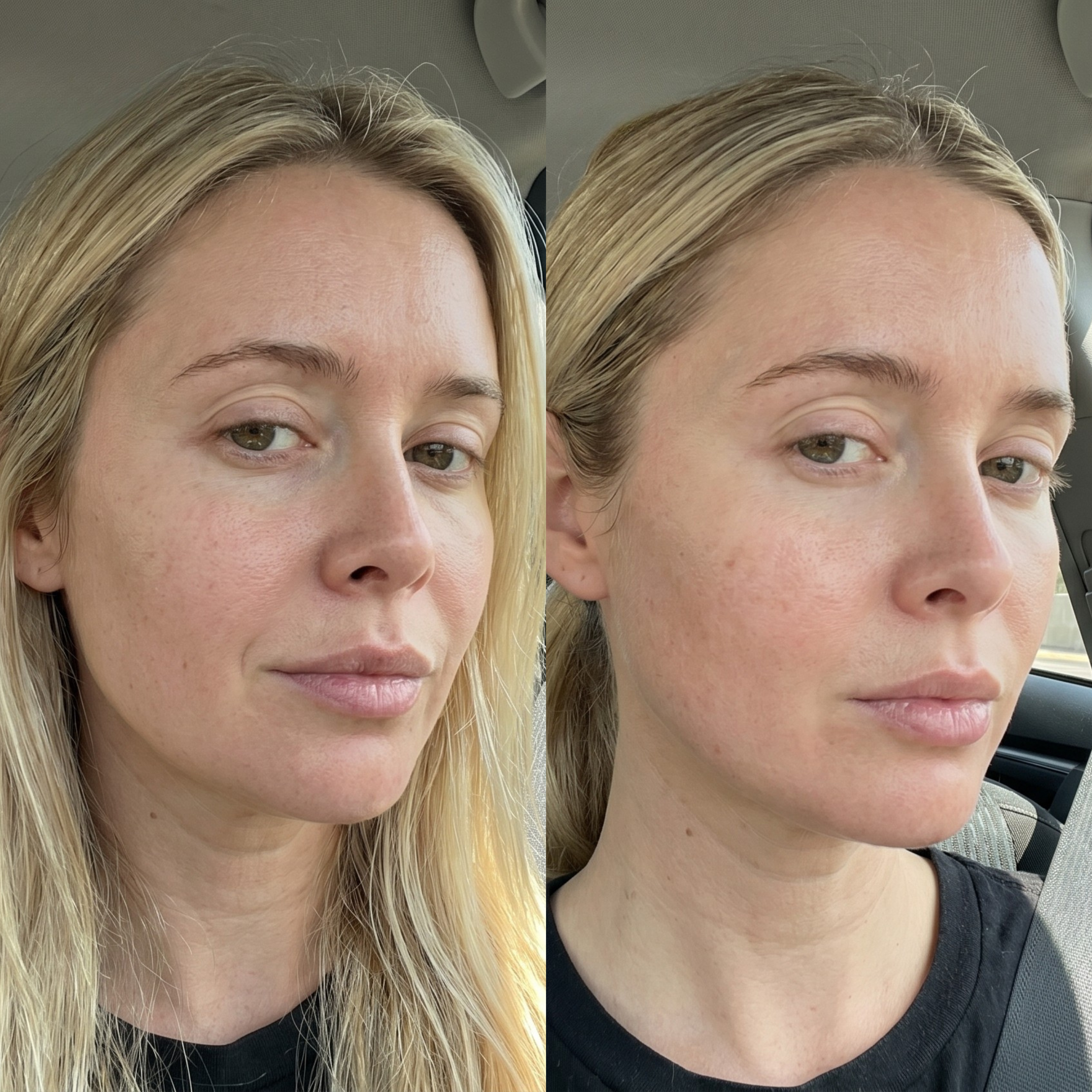 Side-by-side photos showing a close-up comparison of a woman's facial skin.