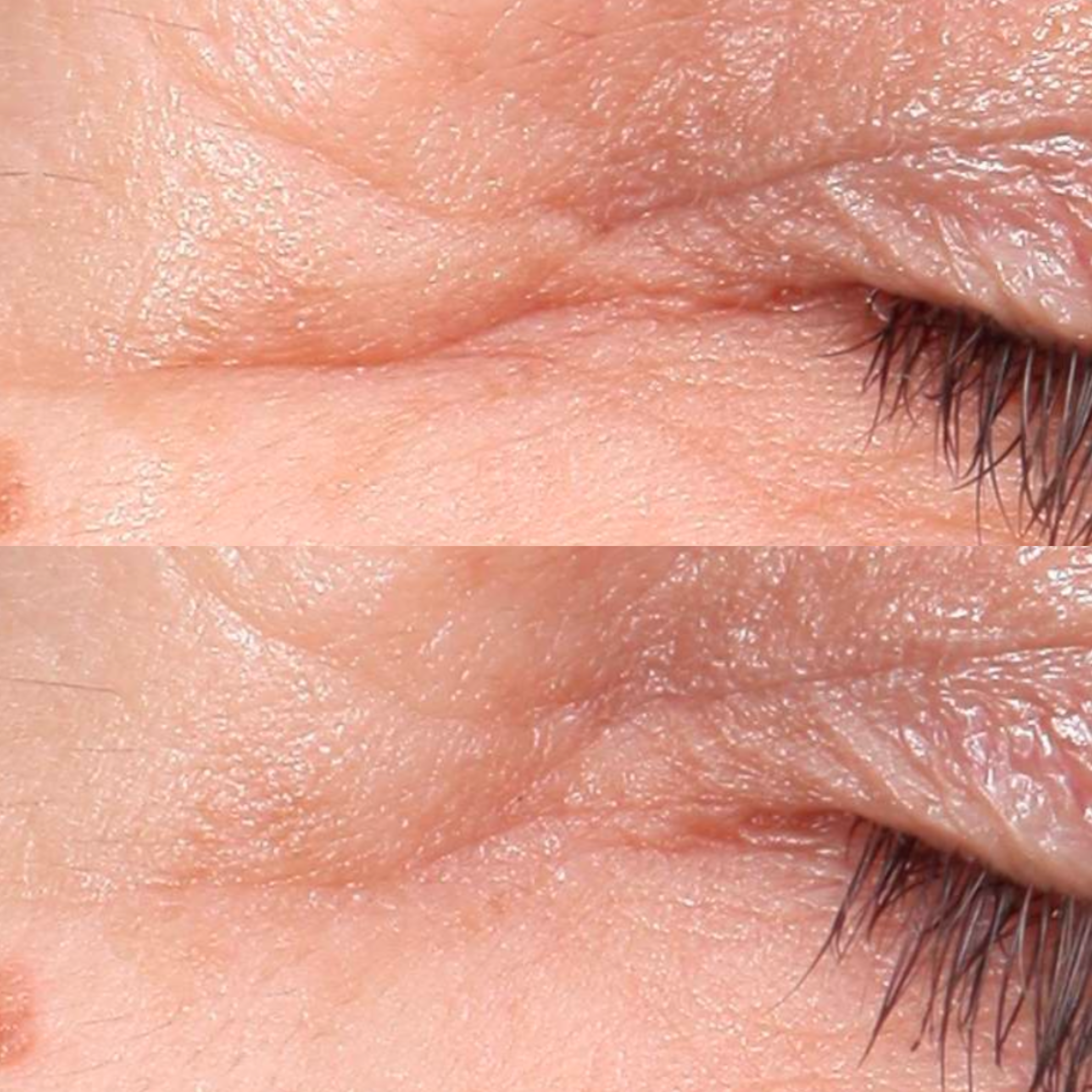 A split before-and-after image showing a close-up of wrinkles around an eye being visibly reduced.